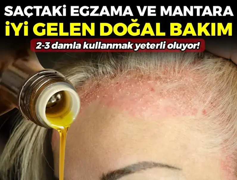 Sa&ccedil; derisindeki egzama, kepek ve mantarın k&ouml;k&uuml;n&uuml; kurutuyor